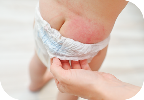 dermatitis del pañal por diarrea