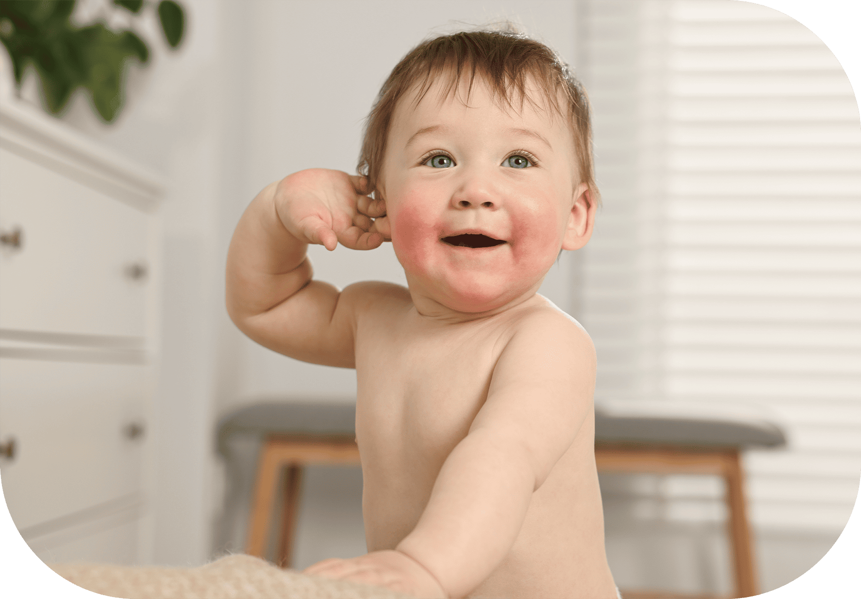 Dermatitis perioral por babeo y mocos Dermatitis perioral por babeo y mocos
