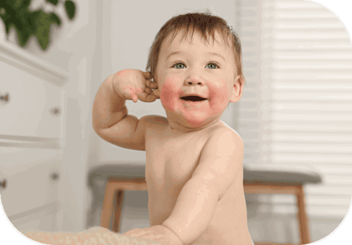 dermatitis perioral