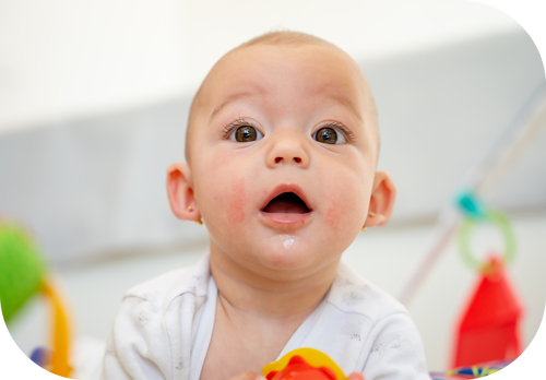 dermatitis perioral