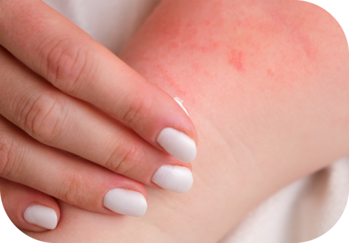 piel de bebé irritada