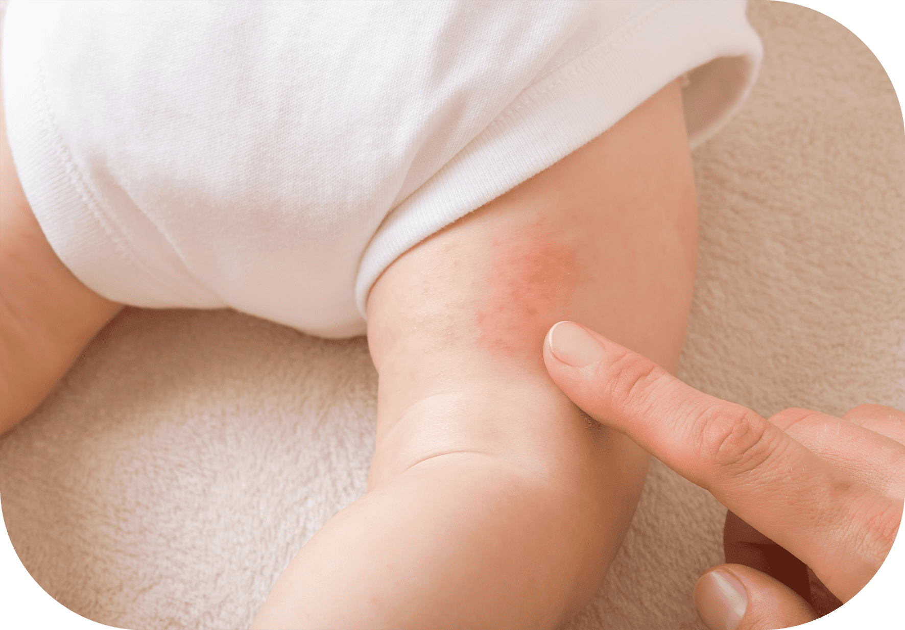 escuela infantil y dermatitis del pañal