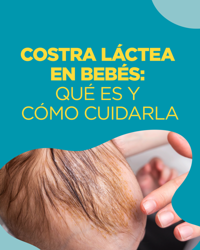 qué es la costra láctea en bebés
